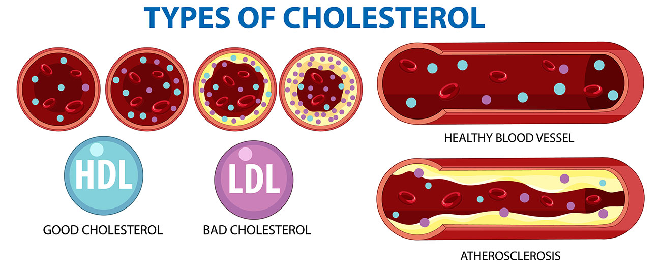 colesterolo hdl ldl